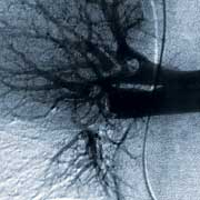 Pictogramme pour l'angiographie et la scintigraphie