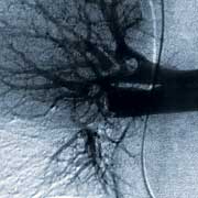 Pictogram for the angiography and the scintigraphy